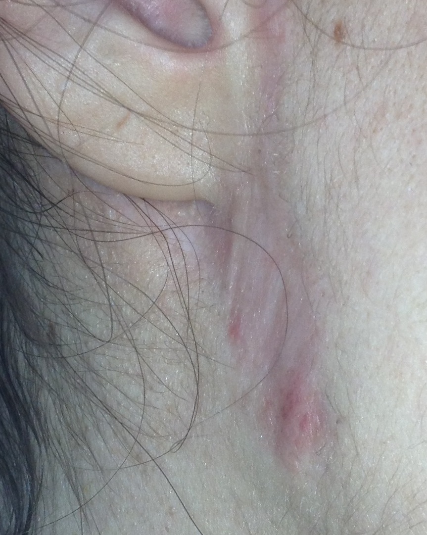 Scar
